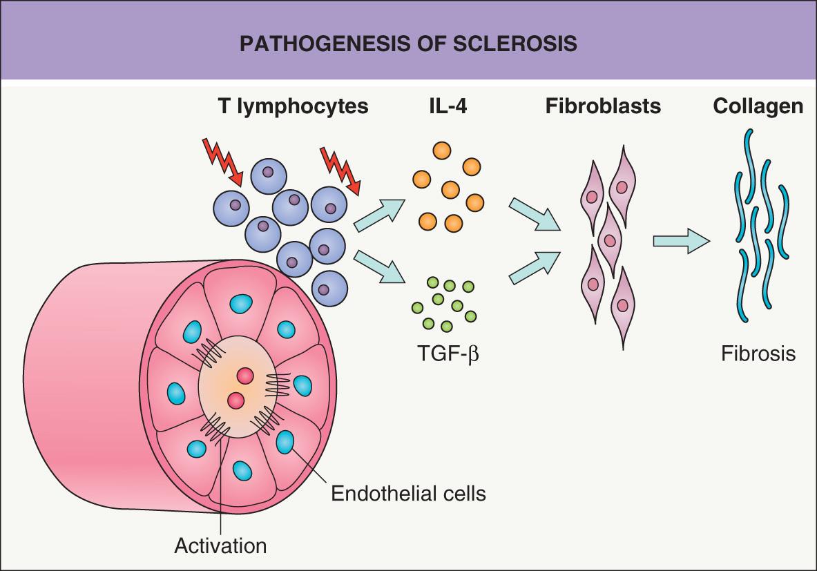 Fig. 44.1, Pathogenesis of sclerosis.