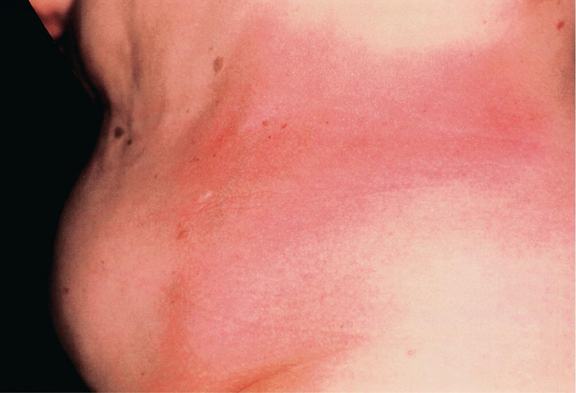 Fig. 44.3, Early inflammatory plaque-type morphea of the trunk.