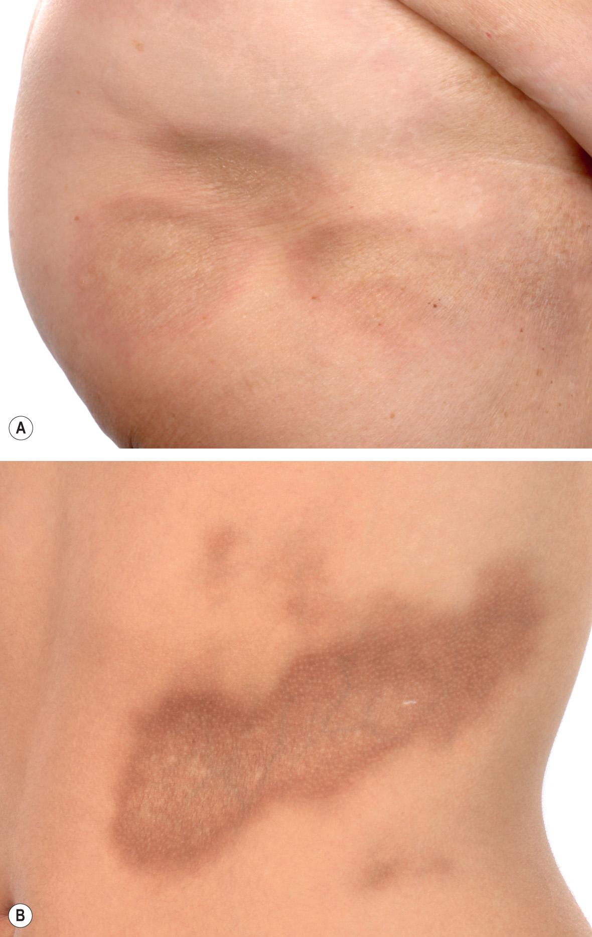 Fig. 44.4, Plaque-type morphea.