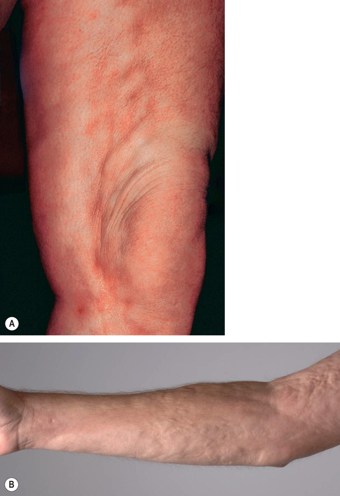 Fig. 44.5, Comparison of deep morphea and eosinophilic fasciitis.