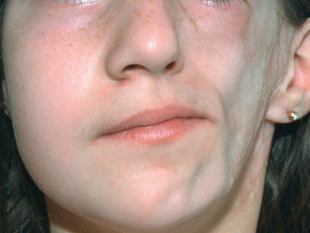 Fig. 44.7, Parry–Romberg syndrome.