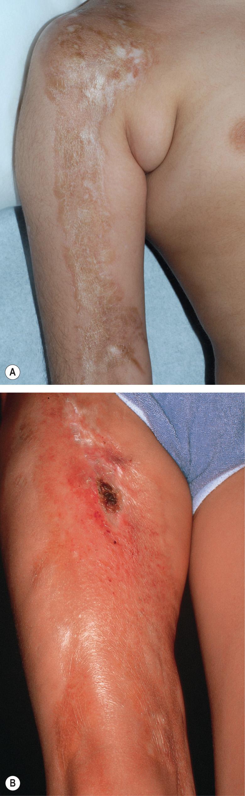 Fig. 44.8, Linear morphea of an extremity.