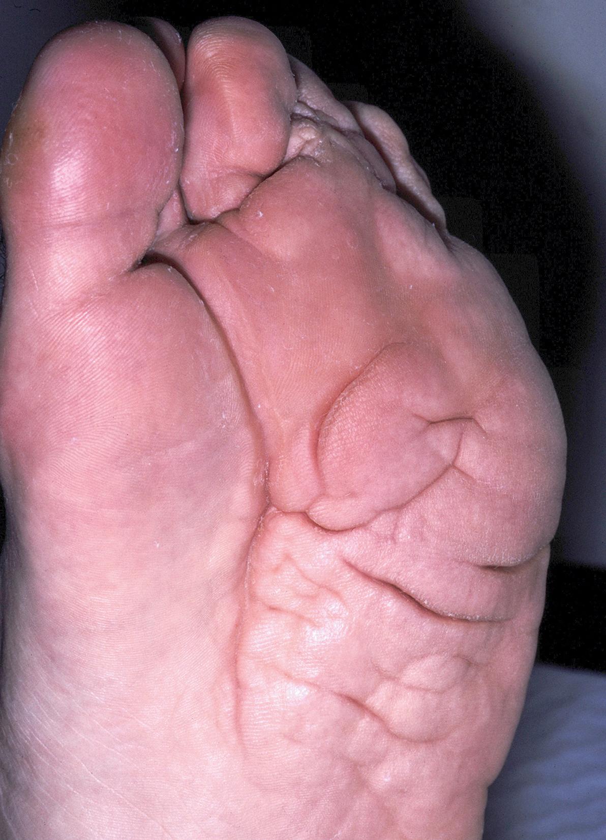 Fig. 51.4, Plantar cerebriform connective tissue nevus in a man with Proteus syndrome.