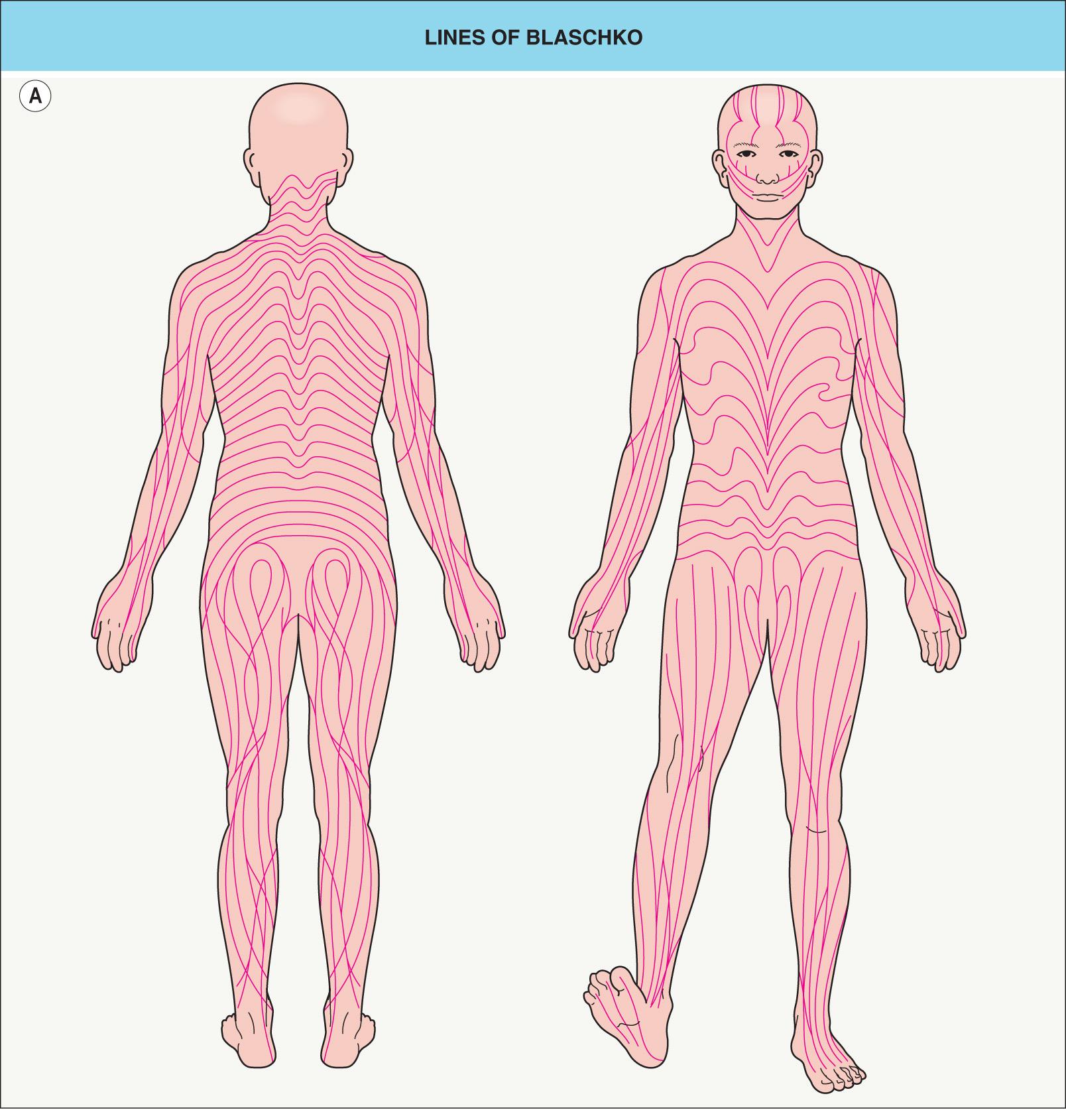 Fig. 62.1, Lines of Blaschko.