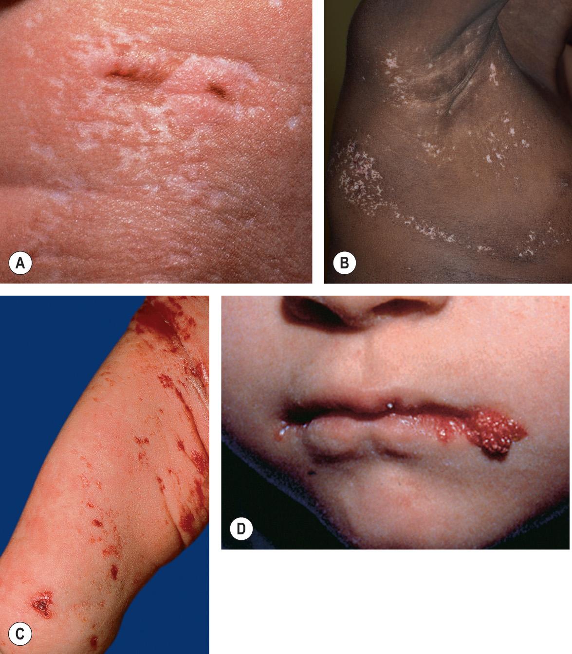 Fig. 62.6, Goltz syndrome (focal dermal hypoplasia).