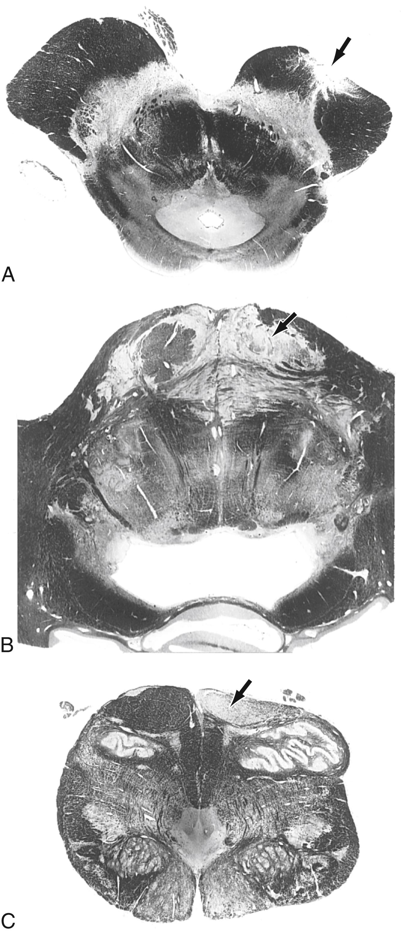 Fig. 25.5, Degeneration of corticospinal fibers, shown in a clinical orientation, caused by an infarction in the posterior limb of the internal capsule. The degeneration serves as a marker to show the position of these fibers ( at arrows ) in the middle third of the crus cerebri ( A ), the basilar pons ( B ), and the pyramid of the medulla ( C ). This lesion is on the patient’s left and resulted in right-sided deficits.