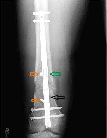 Fig. 27.1, Acute correction of valgus deformity from posttraumatic growth arrest was performed, and then gradual lengthening followed. Blocking screws (orange arrows) were placed in the concavity of the deformity. The magnet (black arrow) and distraction rod with 20-mm lengthening (green arrow) are seen.