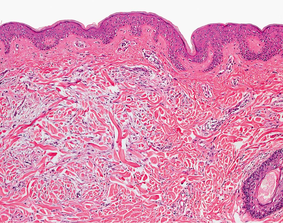 Fig. 46.4, Scleromyxedema – histopathologic features.