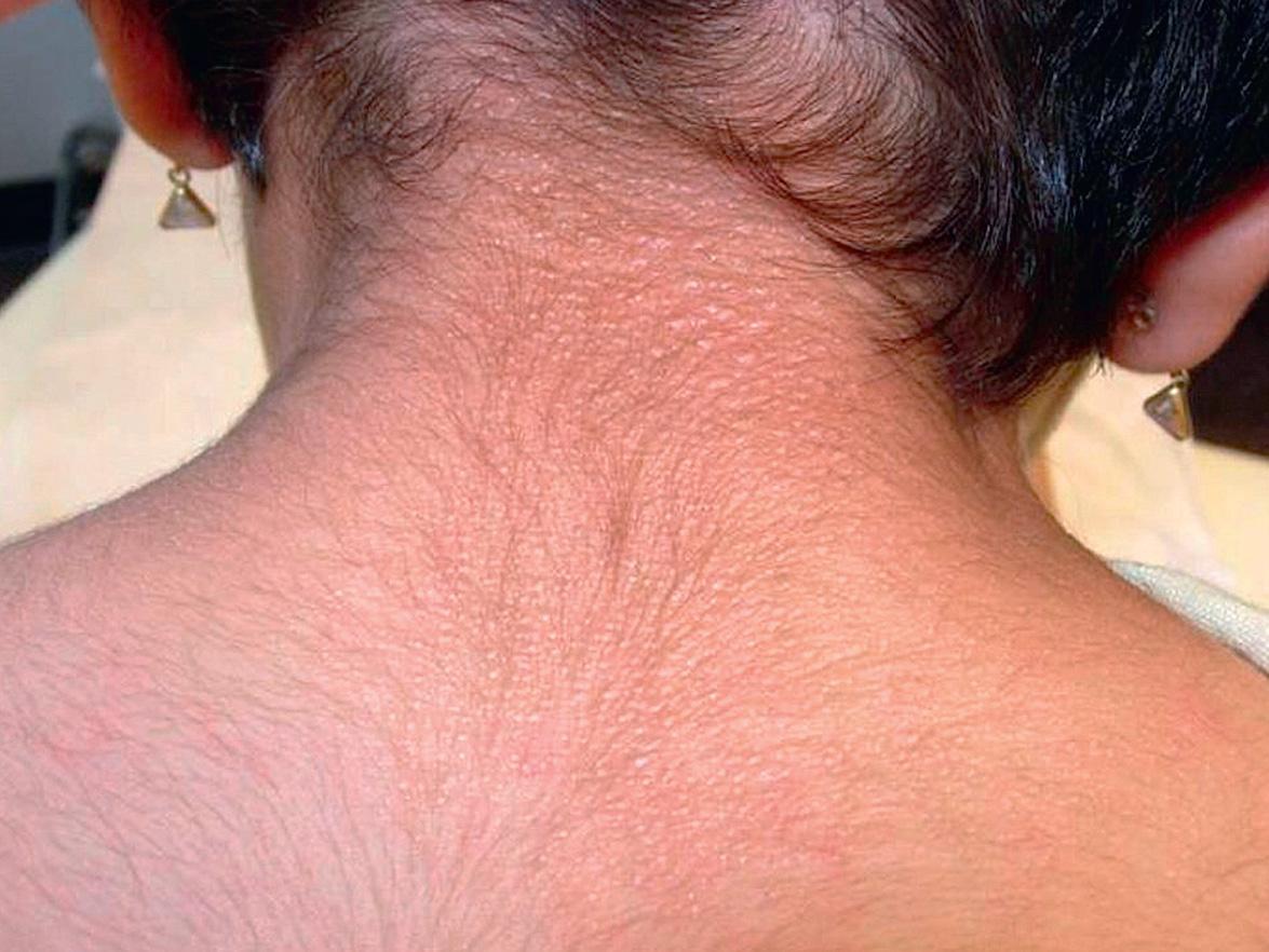 Fig. 46.7, Cutaneous mucinosis of infancy.