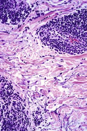 FIGURE 6-4, Reticular erythematous mucinosis. Interstitial mucin deposition associated with perivascular lymphocytic infiltrate.