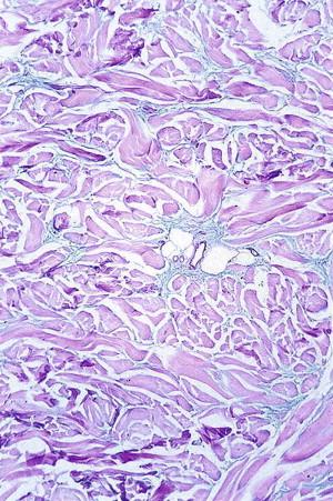 FIGURE 6-5, Scleredema. Interstitial mucin deposition between fenestrated collagen highlighted by Alcian blue stain.