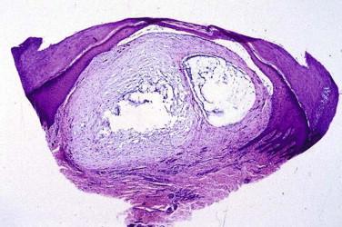 FIGURE 6-6, Cutaneous myxoid cyst. Dermal nodule of mucin and fibroblasts flanked by the epidermis.