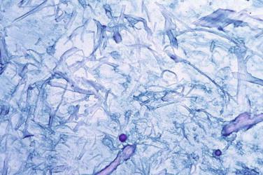 FIGURE 6-7, Follicular mucinosis. Mucin accumulates within the follicular epithelium with some dissolution of cellular attachments.