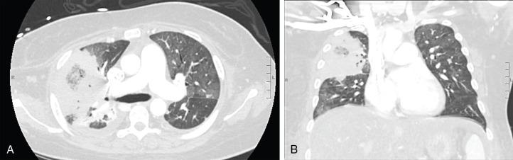 Fig. 25.1, Reverse halo sign in a patient with pulmonary mucormycosis. (A) Axial and (B) coronal views of a large consolidation with central hypodensity in the right upper lobe.