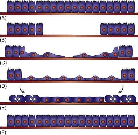 Fig. 29.1, The basic processes of intestinal epithelial wound healing. When an undamaged mucosal surface (A) is subjected to an insult, which strips away epithelial cells (B), the first response is loss of polarization of cells near the wound margin and conversion to a migratory phenotype (C). Over a process of minutes to hours depending on the extent of the wound, cells flatten and move to cover the denuded area, reestablishing the protective barrier (D). Leader and follower cells often move as a unified sheet, maintaining rudimentary attachments during the restitution process. Cell proliferation restores the epithelial population (E), allowing cells to reform normal junctional complexes and retrieve a polarized columnar phenotype (F).