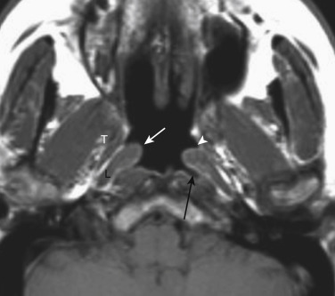 FIGURE 13-1, Normal nasopharyngeal anatomy. The torus tubarius (white arrow), eustachian tube orifice (white arrowhead), and fossa of Rosenmüller (black arrow) are labelled. The tensor veli palatini (T), and levator veli palatini (L) are seen.