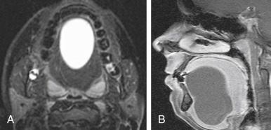 FIGURE 13-11, (Epi) Dermoid cyst of tongue. A, Axial T2-weighted imaging (T2WI) is dominated by the very bright midline mass in the oral tongue. It is too anterior to be a thyroglossal duct cyst and not lateral or inferior enough to be a ranula. B, The sagittal postcontrast T1WI confirms the cystic nature of the mass by virtue of the absence of enhancement.