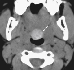 FIGURE 13-12, Lingual thyroid. This axial coronal computed tomographic image shows a mass (arrow) in the base of the tongue that is hyperdense on a noncontrast scan. Think thyroid that thoroughly thickens the throat thereabouts.