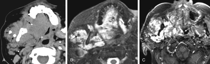 FIGURE 13-13, Venous vascular malformation: VVM (Va Va vooM!) A, Axial computed tomographic (CT) image without contrast gives us the sense that there is bulky soft-tissue mass investing the masticator space (masseter and pterygoid musculature) and oral cavity. Note effacement of the parapharyngeal fat on the right (normal space on the left indicated by P ). There are chunky phleboliths (arrows) scattered throughout the lesion. B, Axial T2-weighted image (T2WI) makes the extent of the lesion more clear, given its intrinsic high T2 signal. Note the dark signal from the phlebolith (arrow) , much more difficult to discern compared to CT. C, The lesion enhances on postcontrast T1WI. There is mass effect from this lesion on the nasophayngeal airway (arrow) .