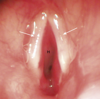 FIGURE 13-14, Subglottic hemangioma. This endoscopic view shows the subglottic hemangioma (H) below the true cords (white arrows). The airway below the true cords is compromised. (Courtesy David Tunkel, MD.)