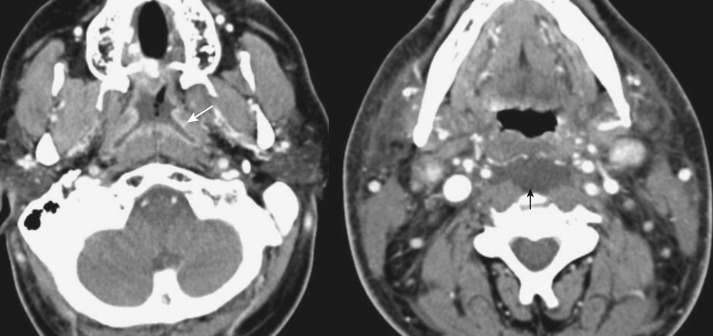 FIGURE 13-15, Pharyngitis with retropharyngeal edema. The patient has a rip-roaring nasopharyngeal pharyngitis evidenced by the enhancing mucosa (white arrow). There was resultant retropharyngeal edema (black arrow) without an abscess. An abscess would have a better defined and enhancing peripheral border.