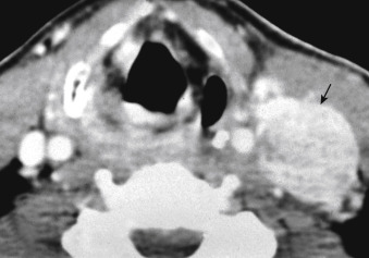 FIGURE 13-17, Castleman disease. The nodal mass (arrow) on this enhanced computed tomographic scan enhanced very avidly. Such an enhancing node is suggestive of angiofollicular hyperplasia (Castleman disease), thyroid carcinoma, Kaposi sarcoma, some lymphomas, and Kimura disease.