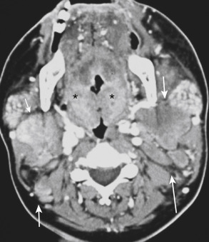 FIGURE 13-18, Large lymph nodes with Waldeyer ring lymphoid hyperplasia. Note the enlarged lymph nodes (arrows) in the neck and the enlargement of Waldeyer ring tissue in the palatine tonsils (asterisks). Differential diagnosis includes acquired immunodeficiency syndrome, amyloidosis, mononucleosis, lymphoma, sarcoidosis, or pharyngeal carcinoma with malignant lymphadenopathy among other infectious/inflammatory processes. This is where the clinical context needs to come in, and biopsy if that is inconclusive.