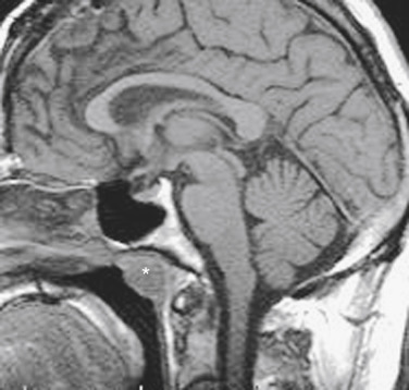 FIGURE 13-2, Adenoidal hypertrophy. The width of the nasopharyngeal adenoid tissue (asterisk) is enlarged in human immunodeficiency virus (HIV) patients and is one of the findings to check for on sagittal T1-weighted imaging scans of the brain. Diminished marrow signal intensity, posterior triangle nodes, and parotid cysts may be other signs of early HIV.