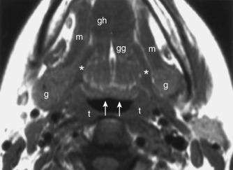 FIGURE 13-4, Normal anatomy of the oropharynx. On this axial T1-weighted imaging scan, one can identify the base of the tongue with lingual tonsil tissue (arrows) and the palatine tonsils (t). Also identifiable on this scan are the submandibular glands (g), the sublingual space extending from the submandibular glands anteriorly, and the midline fatty lingual septum with posterior aspect of the genioglossus muscles (gg) on either side. Muscles on either side of the sublingual space are the mylohyoid muscles (m) laterally and the hyoglossus (asterisks) medially. Geniohyoid muscle (gh) makes up the bulk of the tissue anteriorly in the tongue usually below genioglossus, partially included here.