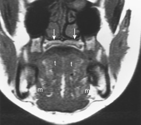 FIGURE 13-5, Normal anatomy of the oral cavity. The hard palate (arrows), the anterior two thirds of the tongue (t), and the gingival surfaces of the mandible constitute portions of the oral cavity. The oral cavity also includes the floor of the mouth, seen as the mylohyoid (m) muscular sling inferolaterally.