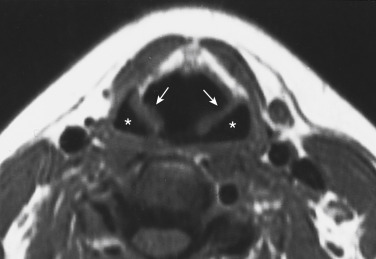 FIGURE 13-6, Anatomy of the hypopharynx. Axial T1-weighted imaging demonstrates the air-filled pyriform sinuses (asterisks), which are delineated anteromedially by the aryepiglottic folds (arrows). Other subsites of the pharynx in this location include the posterior and lateral pharyngeal walls.