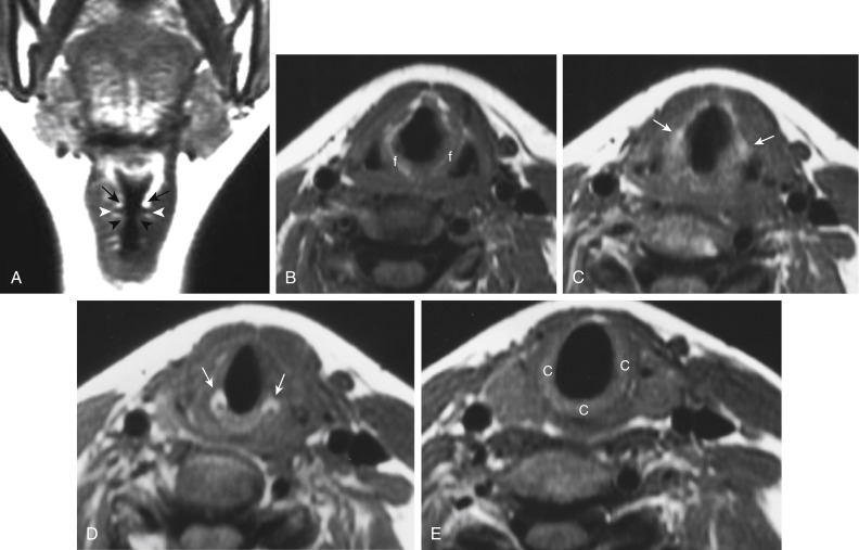 FIGURE 13-7, Normal laryngeal anatomy. A, Coronal T1-weighted imaging (T1WI) shows the laryngeal ventricle (white arrowheads), which separates the false cord (black arrows) above from the true cord below (black arrowheads). Note that at the false cord level the paraglottic tissue is high intensity from fat, whereas below the ventricle the soft tissue is muscular from the thyroarytenoid muscle, which makes up the bulk of the true cord. One centimeter below the ventricle is the margin of the subglottic region. B, Axial T1WI demonstrates the supraglottic structures including the aryepiglottic fold (f) extending posteroinferiorly toward the arytenoid region. C, At the false cord level one can again identify the fat (arrows) in the paraglottic space. D, At the true cord level the paraglottic tissue is made up of the thyroarytenoid musculature. The landmark for the true cord level is the cricoarytenoid joint (arrows). E, Subglottic region is marked by the full cricoid (C) ring.