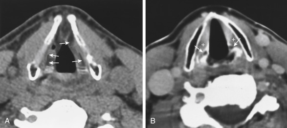 FIGURE 13-8, False cord and true cord levels. A, The false cord is characterized by low-density fat (arrows) in the paraglottic space. B, The true cord is located at the lower cricoarytenoid joint (arrows). The thyroarytenoid muscle (+) makes up the “paraglottic” tissue and this muscle attaches to the vocal process of the arytenoid.