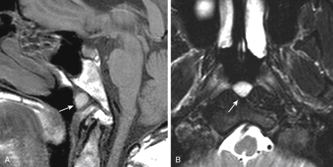 FIGURE 13-9, Tornwaldt cyst. A, Sagittal T1-weighted imaging (T1WI) demonstrates a hyperintense mass (arrow) high in the nasopharynx. B, On the T2WI the Tornwaldt cyst (arrow) is in the midline and bright on this sequence as well.