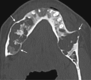 FIGURE 13-10, Cherubism. Computed tomography shows bilateral bubbly lesions of the mandible (arrows) in a patient with cherubism. The expansion without destruction is typical of this entity. The maxilla is also commonly affected.