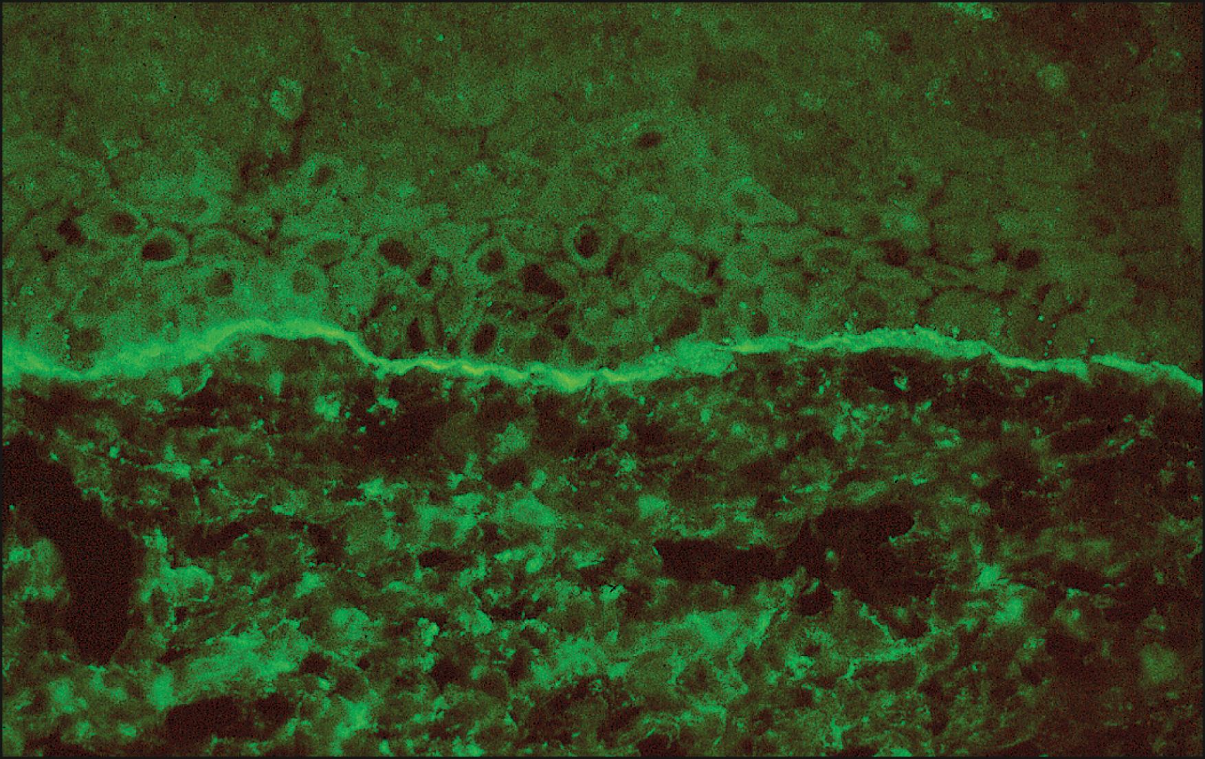 Fig. 45.1, Immunofluorescence microscopy, 40×, conjunctival biopsy from the inflamed bulbar conjunctiva of a patient suspected of having OCP. The cryopreserved tissue has been sectioned at 4 μm and incubated with a rabbit antibody directed against human IgG, fluorescein-labeled. Note the bright apple-green linear pattern of fluorescence at the conjunctival epithelial basement membrane zone, indicating the deposition of IgG at the basement membrane, providing immunohistopathologic confirmation of the suspected clinical diagnosis.