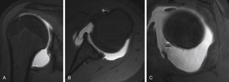 • Fig. 28.2, A, Patulous capsule viewed on coronal T2 magnetic resonance imaging. B, Three-time failure of surgery for “Bankart.” Note the patulous capsule on arthrogram consistent with multidirectional instability on axial image. In this case the patient was referred for testing and diagnosed with Ehlers–Danlos syndrome. C, Sagittal view of the capsule.