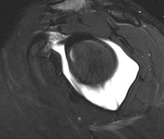 Fig. 42.4, Magnetic resonance imaging scan of a patulous capsule.