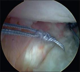 Fig. 42.6, Arthroscopic plication.