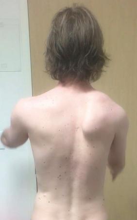 Fig. 3A.1, Scapular dyskinesis where the inferior angle is prominent and the scapular position is protracted and internally rotated.