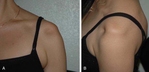 Fig. 3A.2, A and B demonstrates the sulcus sign, in the anteroposterior and lateral views, respectively. One hand stabilizes the scapula while the other hand, not pictured, performs axial traction.