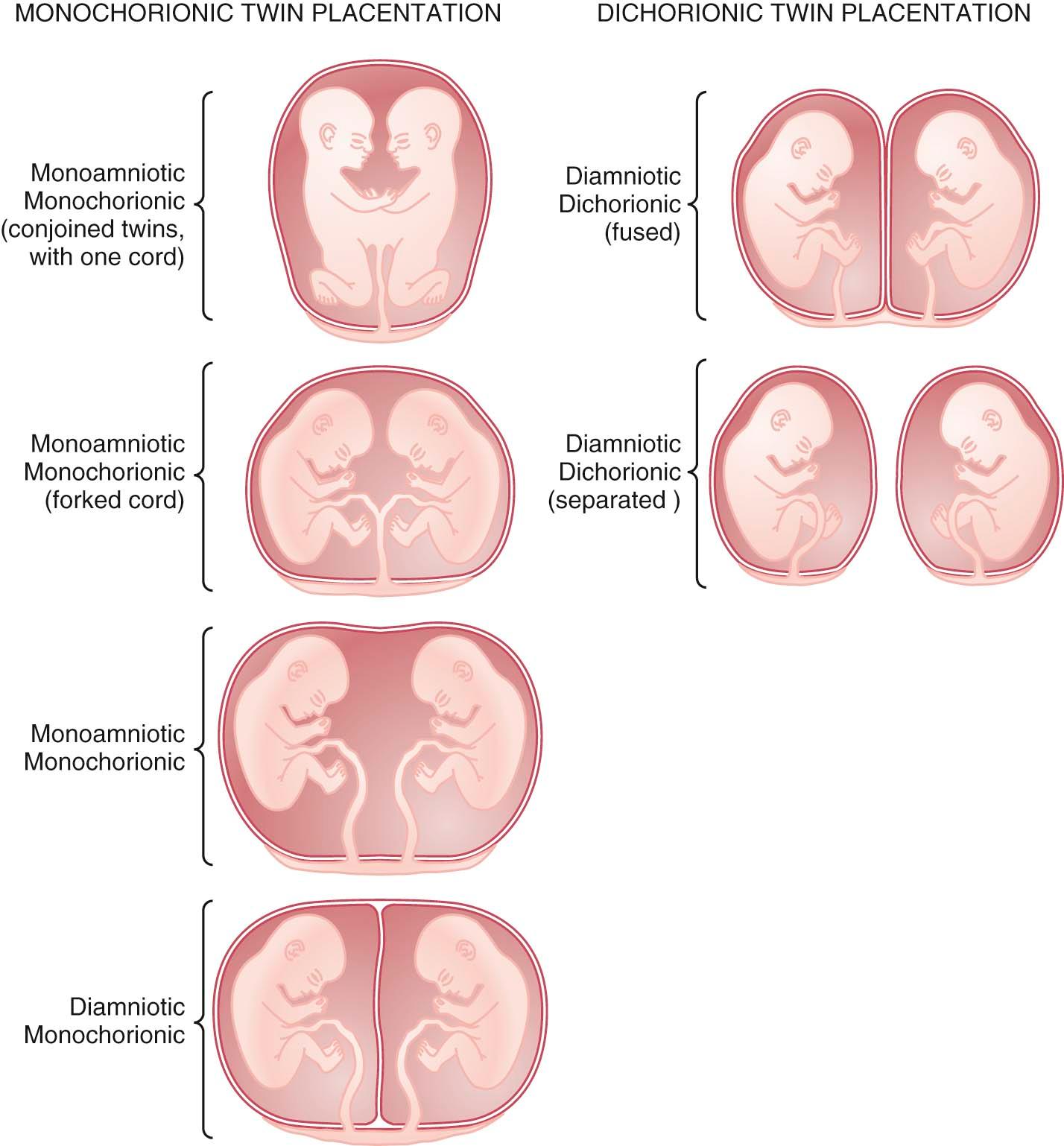 FIGURE 13-1, Diagrammatic representation of the major types of twin placentas found with monozygotic twins.