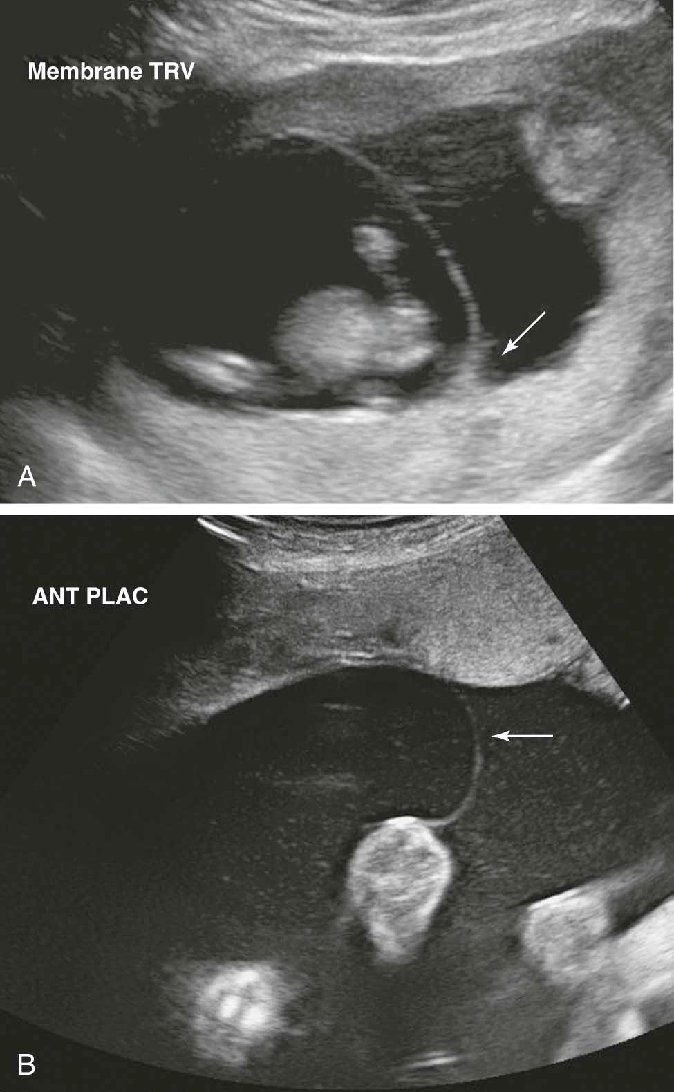 FIGURE 13-2, A, Real-time ultrasound with a thick vertical amnion-chorion septum (membrane) separating one twin (left side) from the second twin on the right. The arrow (right) points to a “peak” or “inverted V” suggesting dizygotic twins. B, Ultrasound of a thin vertical membrane separating one twin on the left side from the second twin on the right suggesting a monochorionic gestational sack. ANT PLAC , Anterior placenta; TRV , transverse view of membrane.