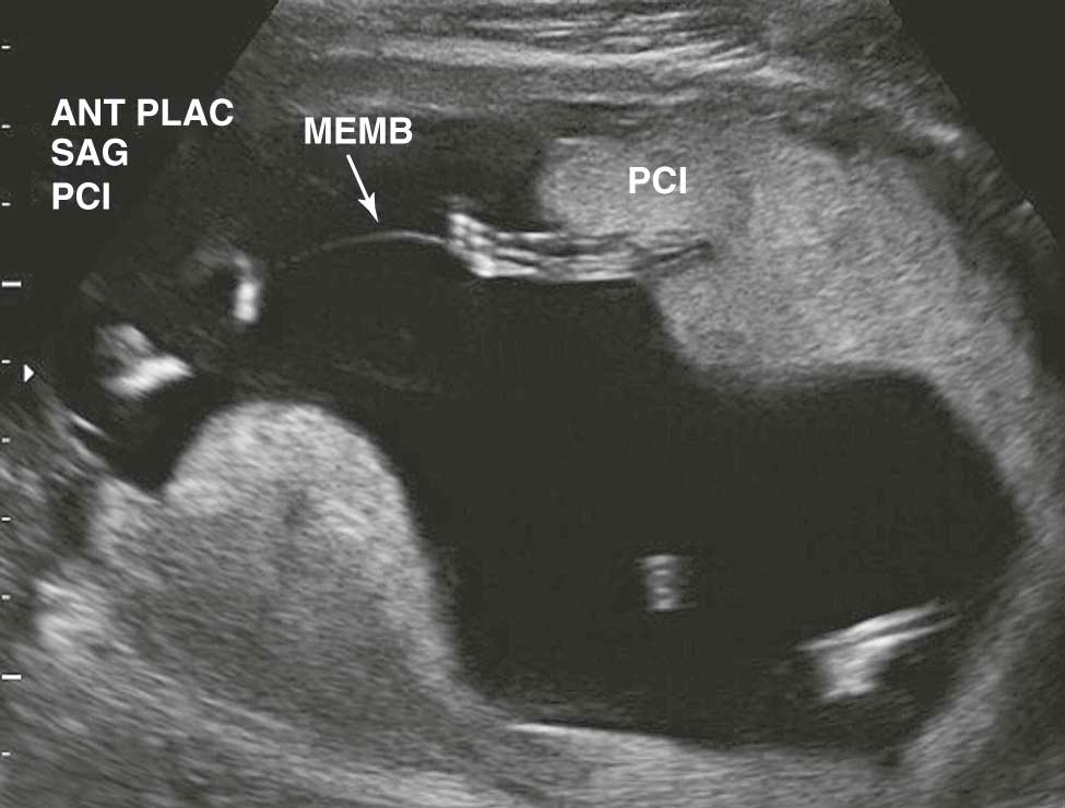 FIGURE 13-3, Ultrasound of a twin-twin transfusion syndrome with one twin (upper left) in an amniotic cavity with a reduced fluid volume and a membrane separating this fetus from the second twin in an amniotic cavity with an excessive amount of fluid (right and lower half of scan image). ANT PLAC , Anterior placenta; MEMB , membrane (amnion); PCI , placental cord insertion; SAG , sagittal view.