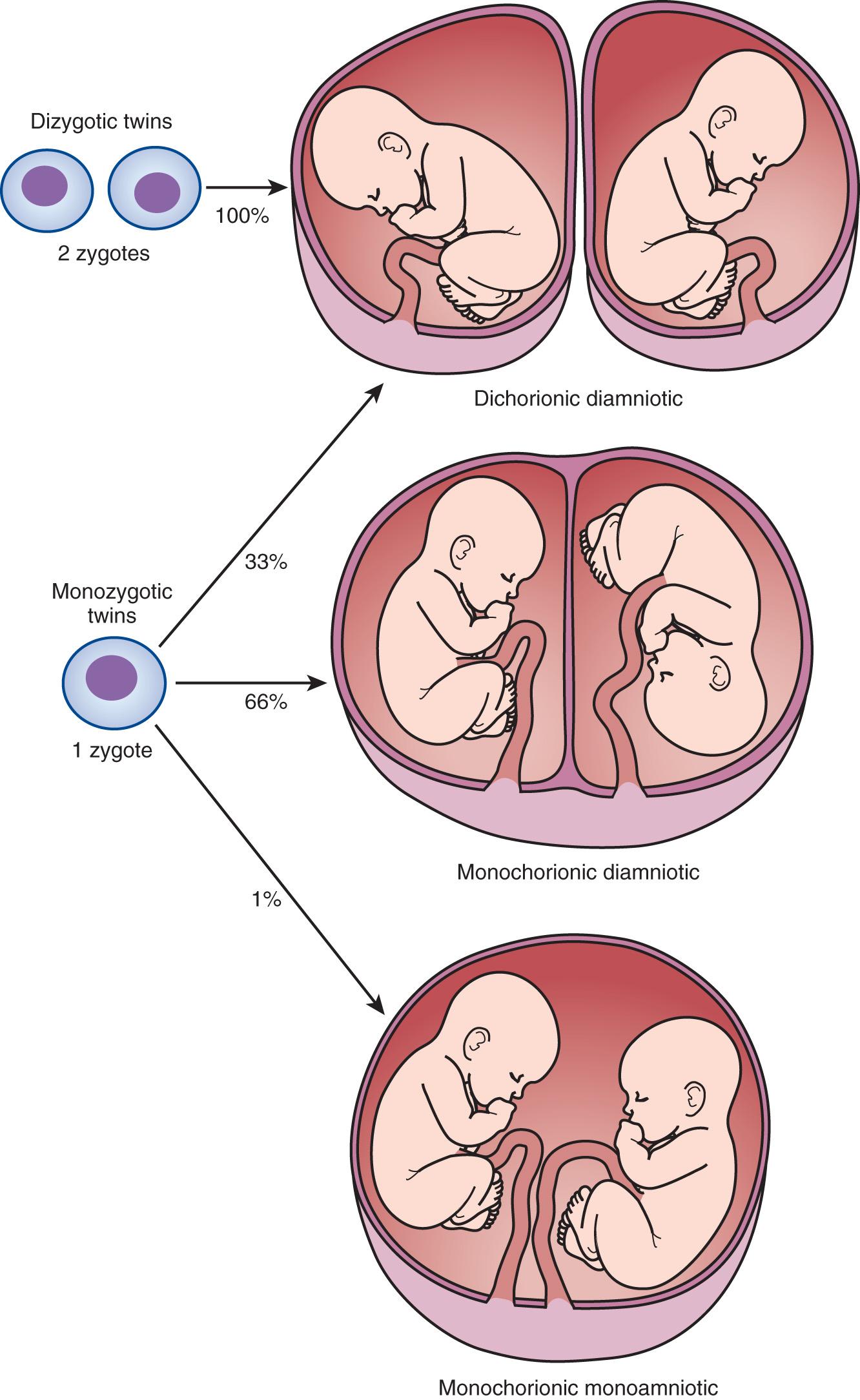 FIG. 32.1, Diagram Illustrating Zygosity and Placentation in Twins.