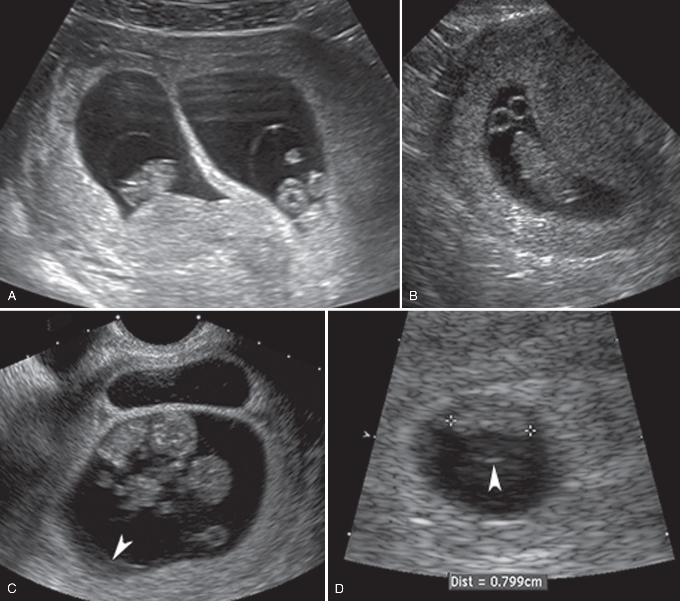 FIG. 32.3, First-Trimester Twins.