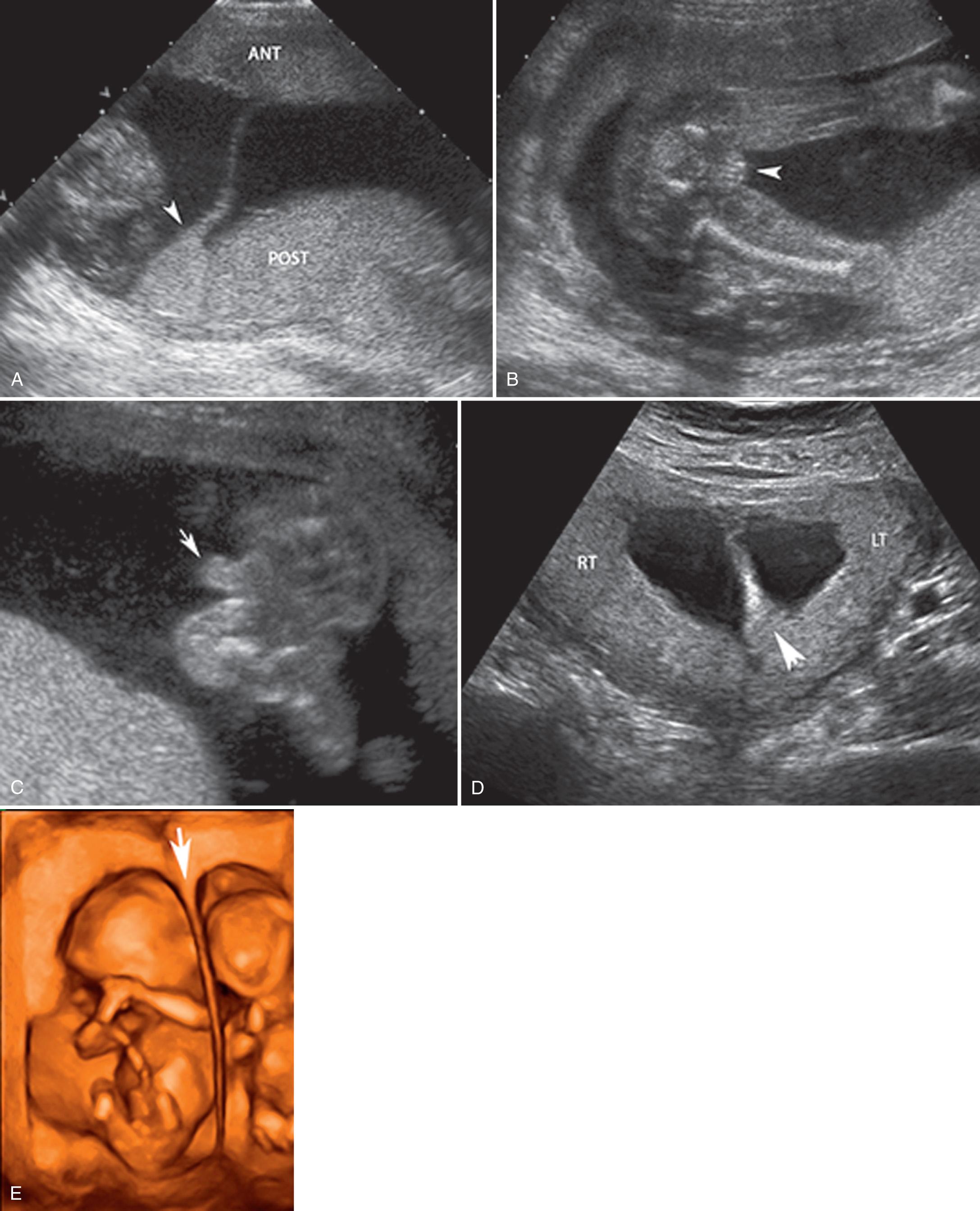 FIG. 32.4, Sonographic Findings Seen With Separate Chorions.