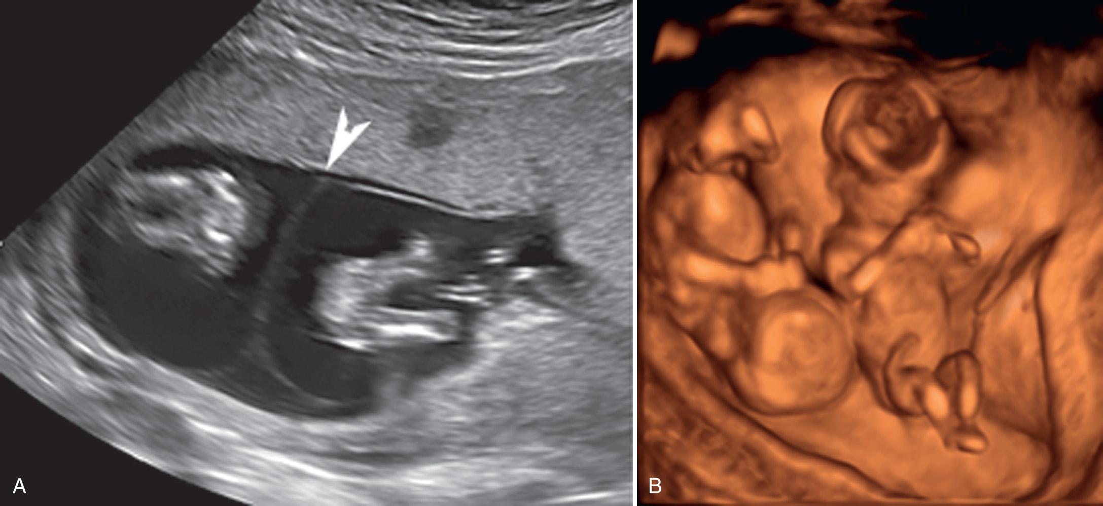 FIG. 32.5, Sonographic Findings Seen With Monochorionic Twins.