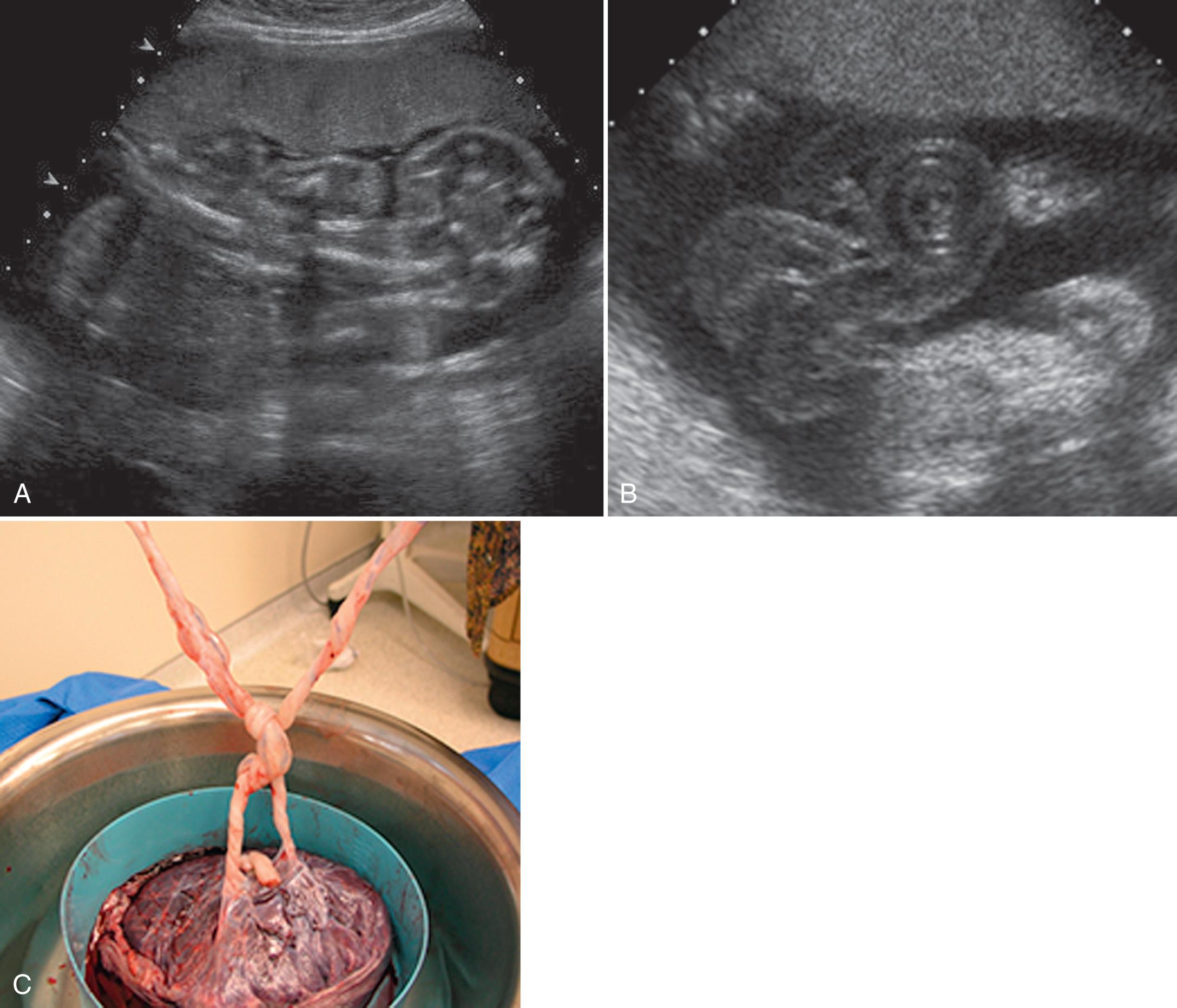 FIG. 32.6, Sonographic Findings Seen With Monochorionic Monoamniotic Twins at 26 Weeks.