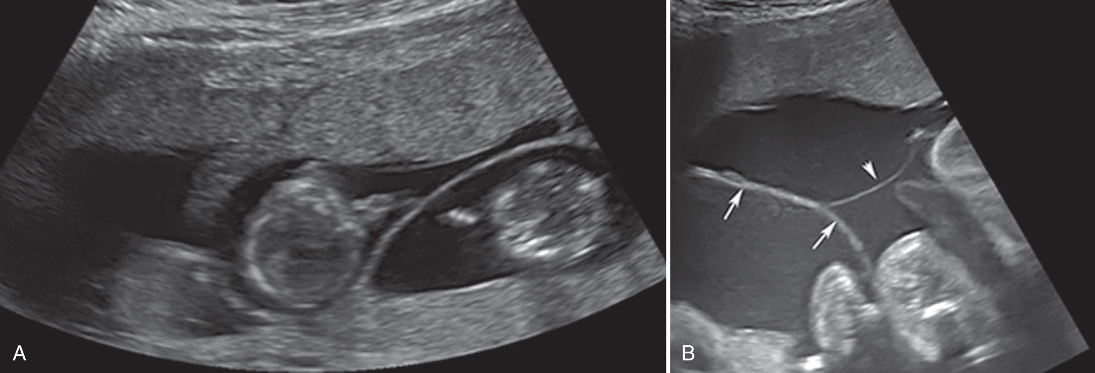 FIG. 32.7, Triplet Pregnancy Categorization.